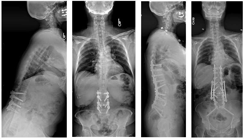 Female with failed back syndrome and kyphosis, treated with an L3 pedicle subtraction osteotomy and T10 to the pelvis fusion