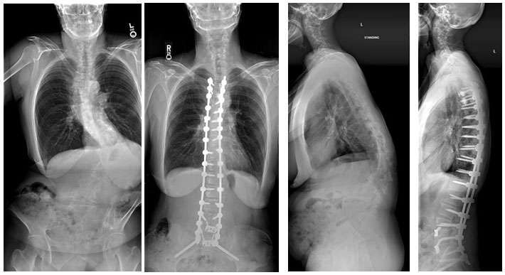 Female patient with kyphosis and lumbar scoliosis, treated with lumbar osteotomies and a T4 to the pelvis fusion