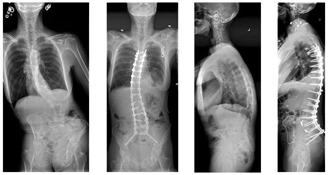 Female with kypho-scoliosis, treated with T5 to pelvis fusion
