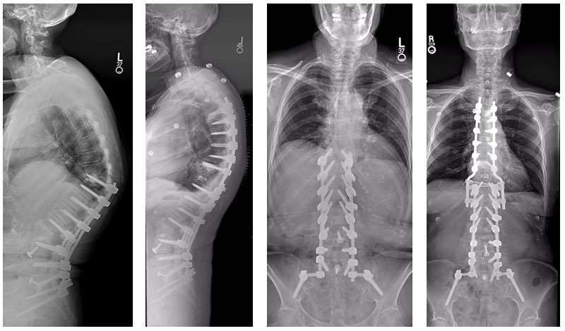 Female with previous deformity surgery and now with proximal junction kyphosis, treated with a T10 vertebral column resection and extension of fusion