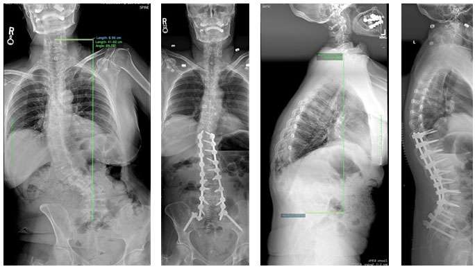 Female with lumbar kyphosis and scoliosis, treated with T10 to pelvis fusion