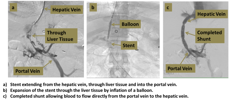 Transjugular Intrahepatic Portosystemic Shunt (TIPS) - Interventional ...