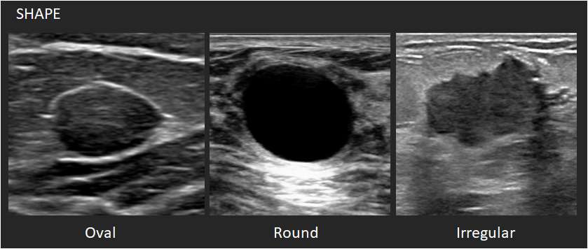 Ultrasounds Mass Shapes