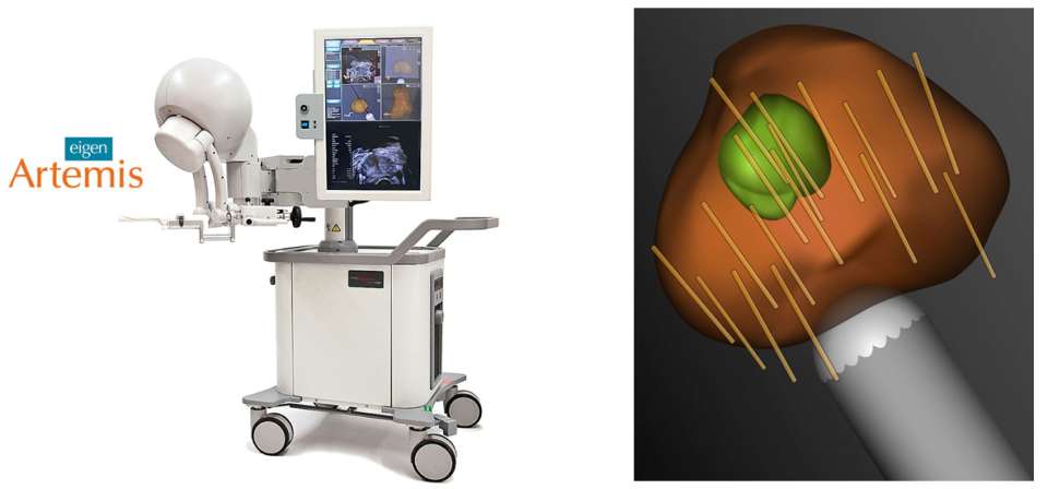 Left – The Artemis device. Right – The MRI identified region of interest is overlaid on a 3D model of the prostate acquired using real-time ultrasoun.