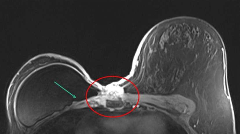 Case: Chest Wall Invasion Figure 3