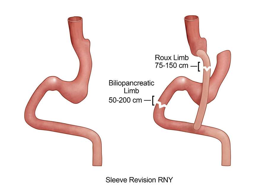 Illustration of Gastric Sleeve Revision RNY