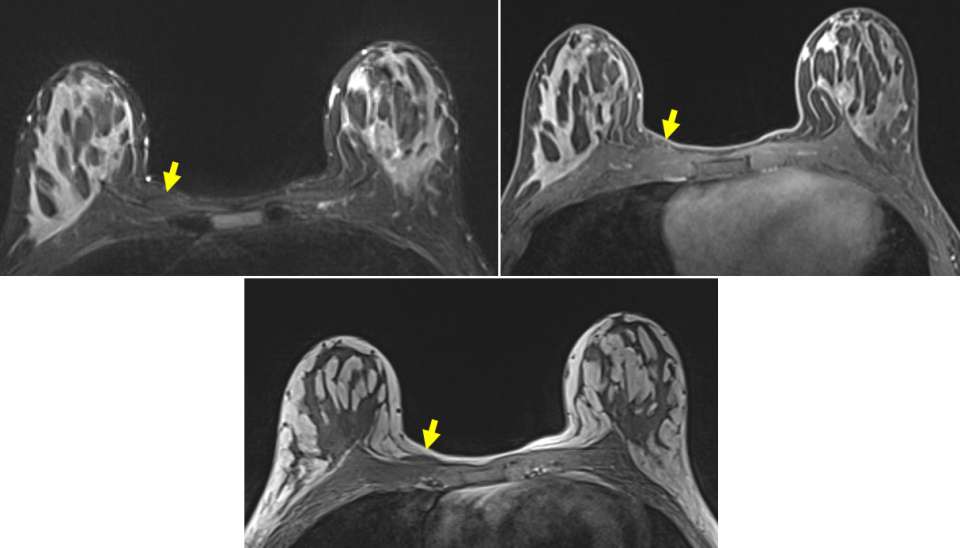 Case: Sternalis Muscle Figure 4