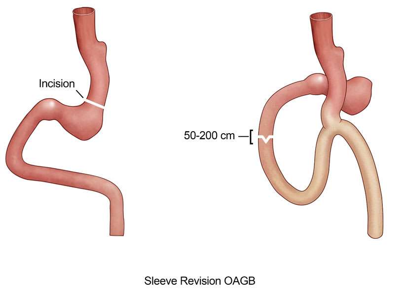 Conversion to One-Anastomosis Gastric Bypass
