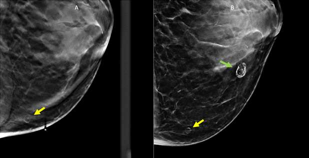 Case: Fat Necrosis of Breast Figure 3