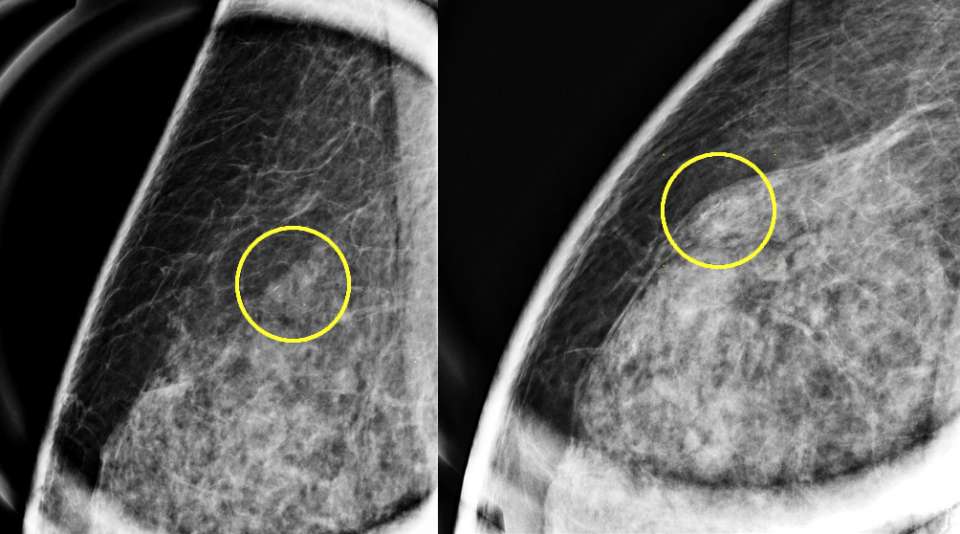 Case: Flat Epithelial Atypia Figure 1