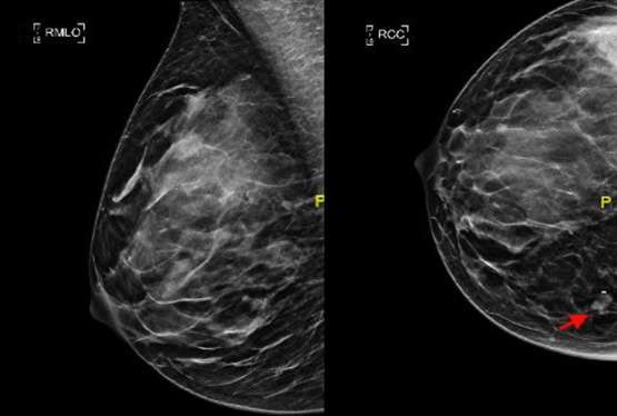 Mass with adjacent microclip is visible in the deep medial breast