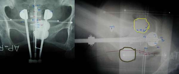 Gynecologic Cancers - Radiation Oncology | UCLA Health Jonsson ...