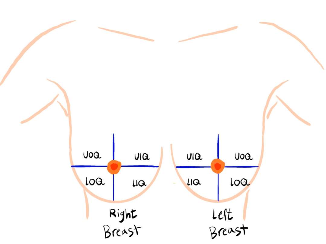 Breast Lesion Localization Radiology UCLA Health
