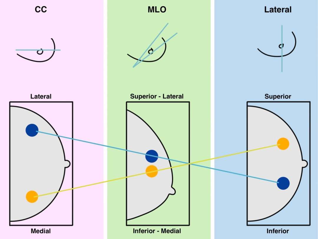 Breast Lesion Localization Radiology UCLA Health