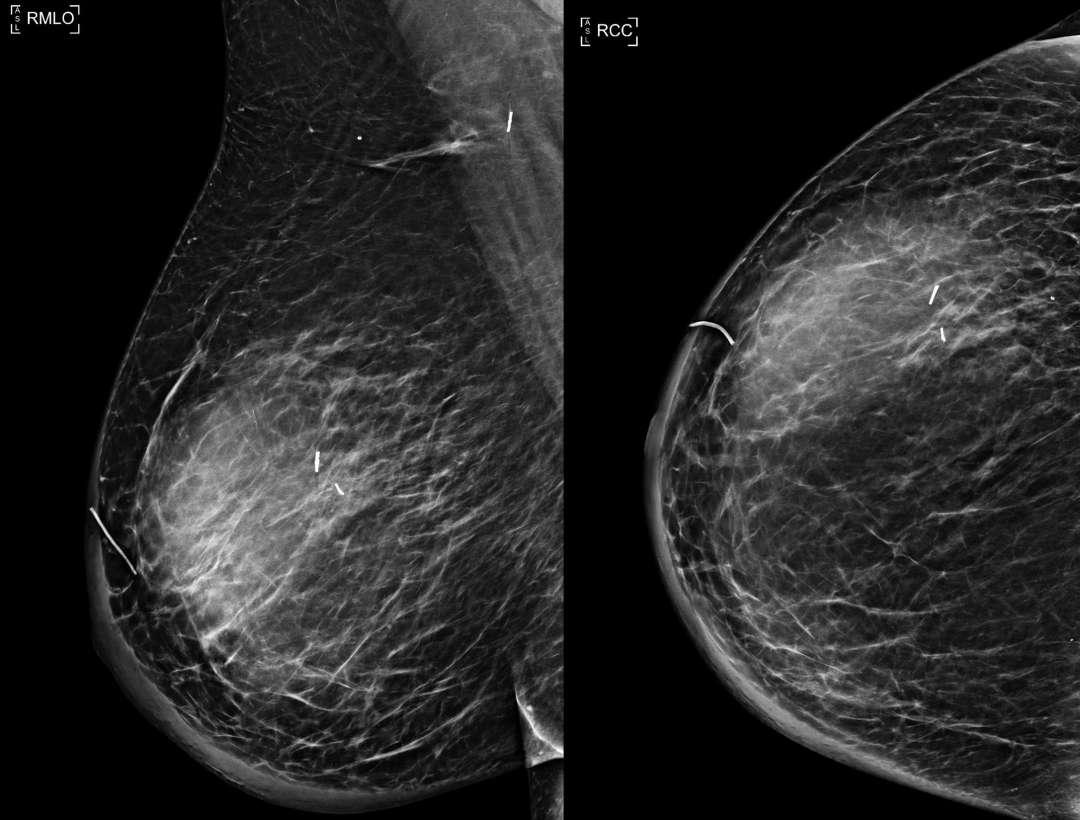 PostSurgical Fluid Collections Causes, Symptoms, and Management