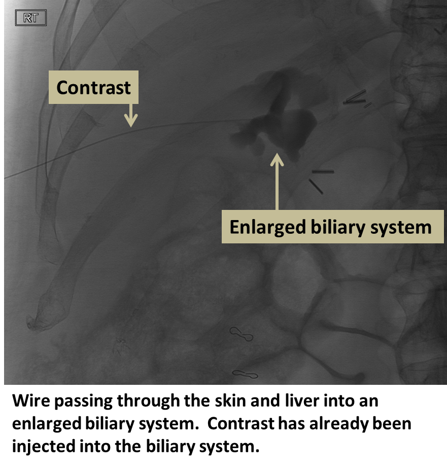 Biliary Drainage Interventional Radiology UCLA Health