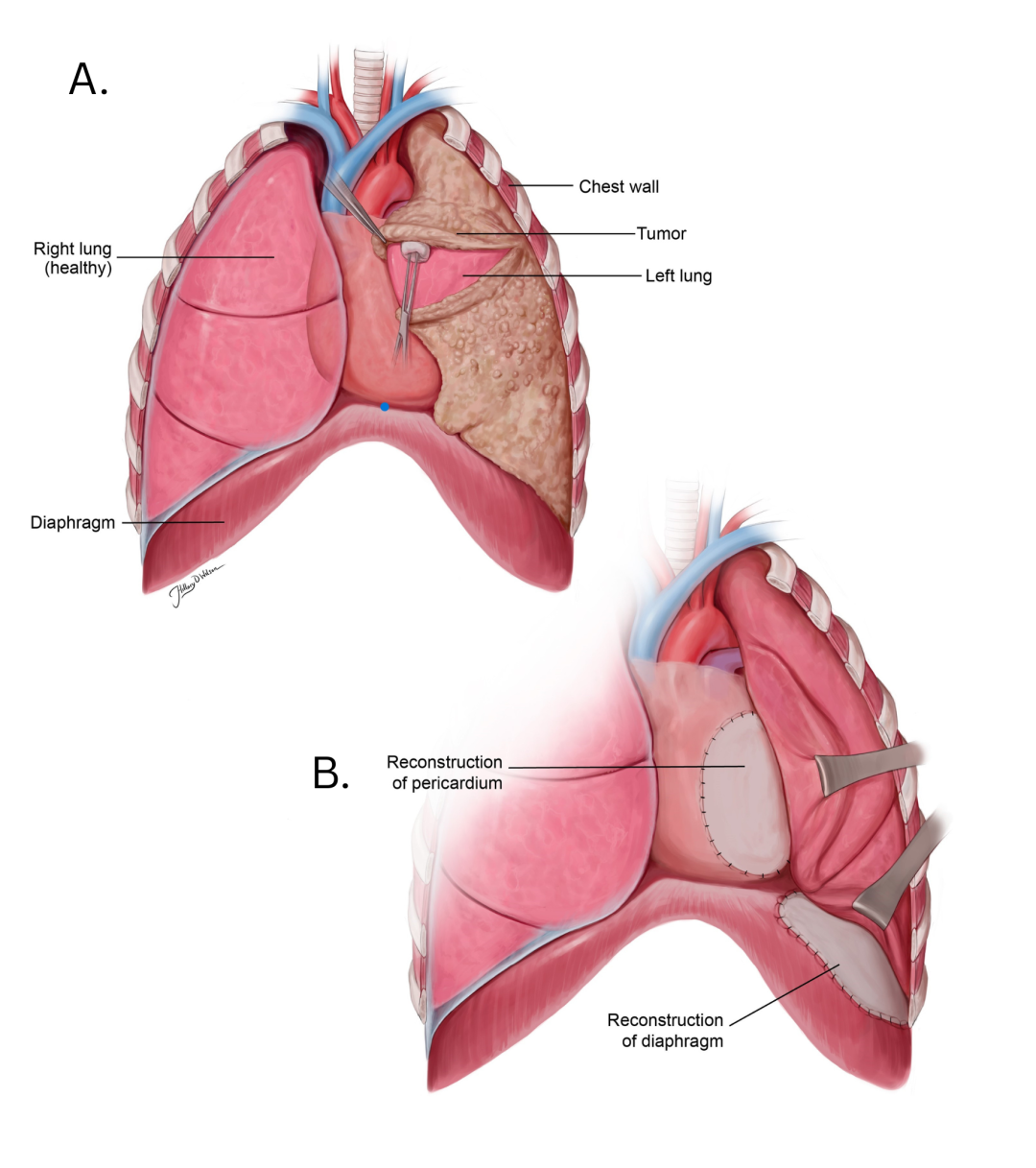 Humh Treatments - Mesothelioma | UCLA Health Jonsson Comprehensive Cancer Center