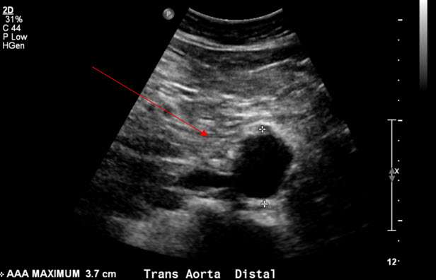Abdominal Aortic Aneurysm - Interventional Radiology | UCLA Health
