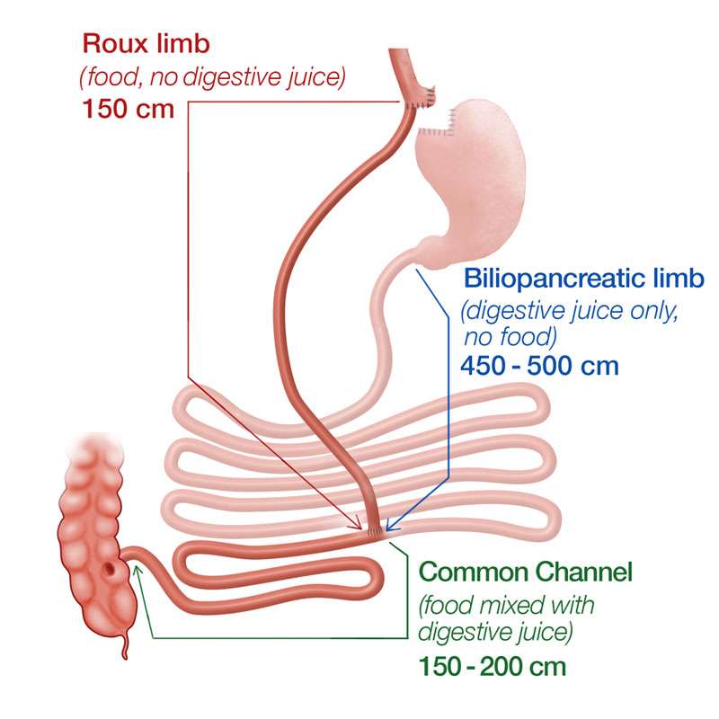 Gastric Bypass Revision Bariatric Surgery UCLA Health