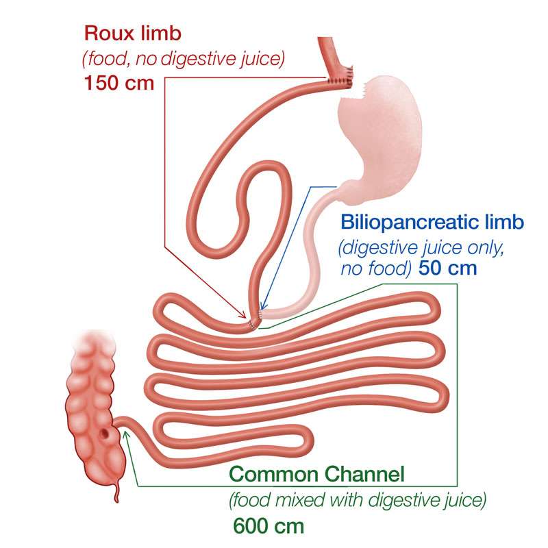 Gastric Bypass Revision Bariatric Surgery UCLA Health