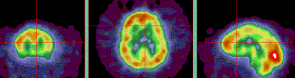 Three brain scans with color gradients indicating different levels of activity.