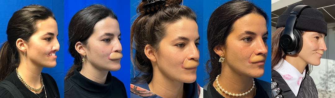 reconstructive surgery progression 