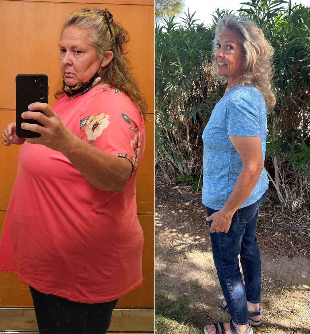 Ruth's Patient Story - Gastric Sleeve, VSG (Vertical Sleeve Gastrectomy ...