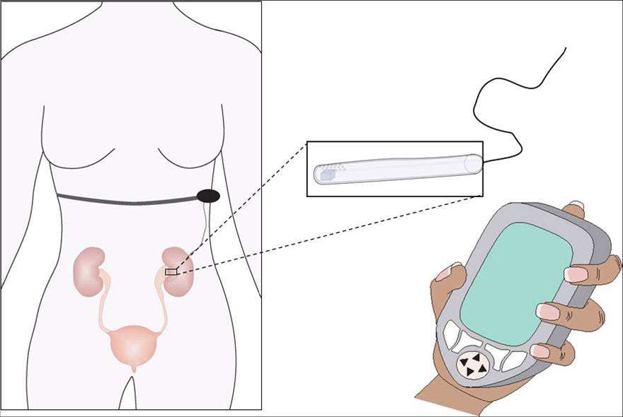 Overview of the wireless sensing system. Sensor is implanted into organ of interest and wirelessly transmitted to a PDA, where it is read and stored