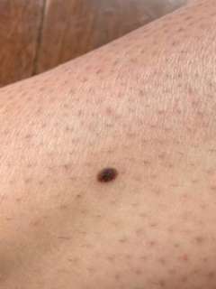 A close-up image of fair skin featuring a single, dark, irregularly shaped mole or skin lesion, potentially indicating a concern.