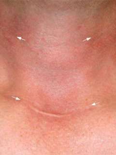 Scar appearance 1 year after radical surgery for metastatic thyroid cancer