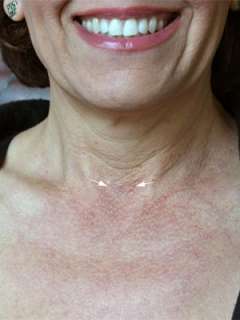 Scar after benign thyroid disease surgery