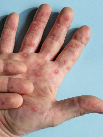 What does the monkeypox outbreak mean for people living with HIV?