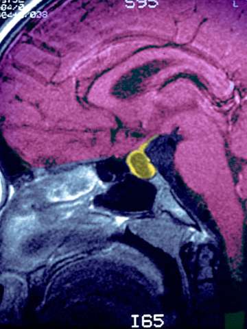 Pituitary Tumor Scan
