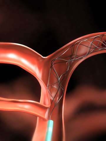 Vein Procedure, Interventional Neuroradiology