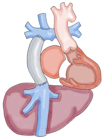 Heart and Liver Disease - Fontan Physiology