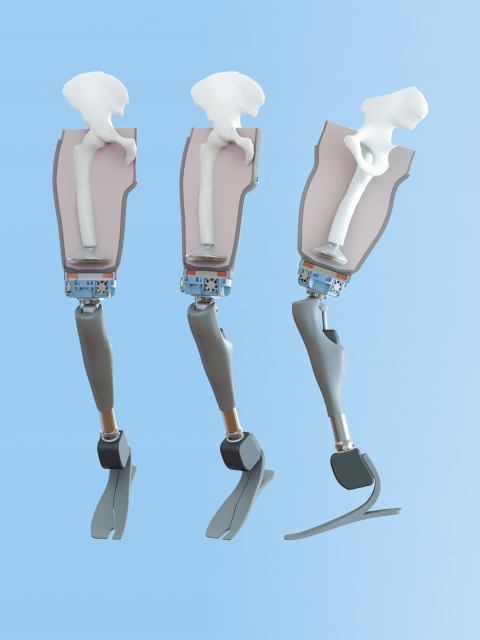 Implanted magnetic attachment prosthetic