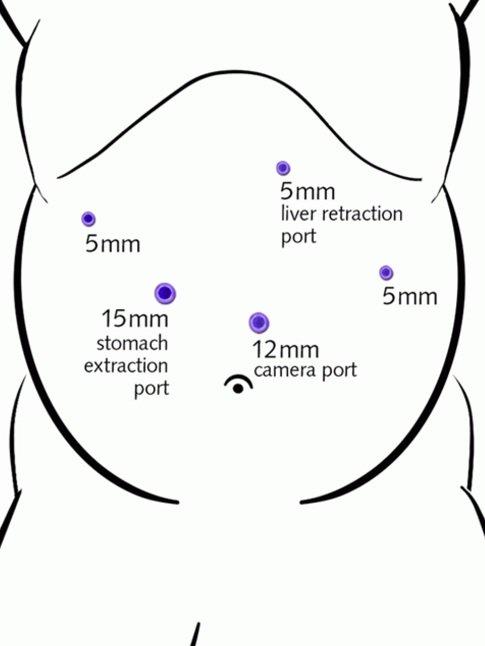 Gastric Sleeve Bariatric Surgery UCLA Health
