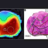 AI map of prostate tumor.