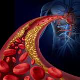 Cholesterol lining walls of artery
