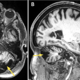 MRI brain of post-stroke cerebellar lesion.